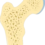 Pilates and Osteoporosis femoral neck