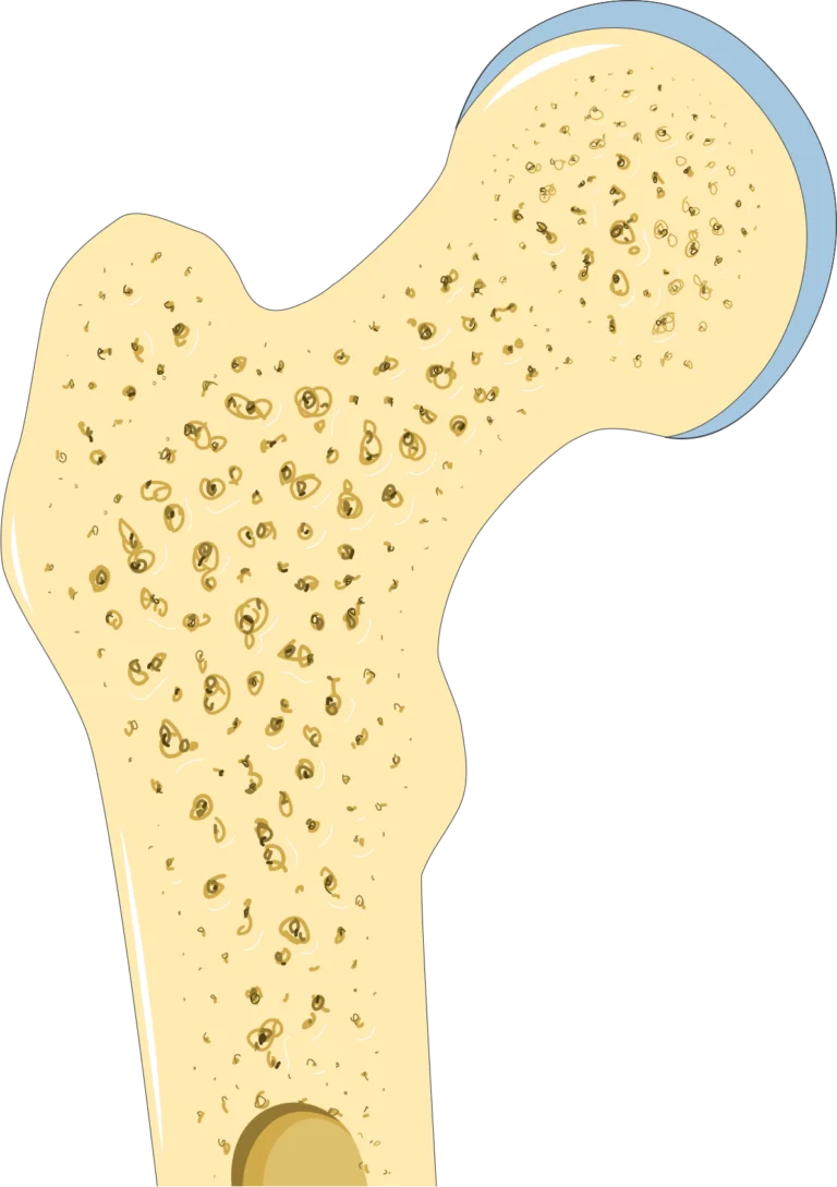 Osteoporosis-femur-head